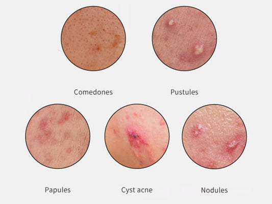 A little knowledge of skin care every day: knowing acne